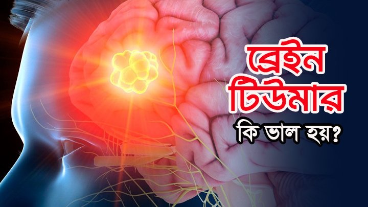 ব্রেন টিউমার অপারেশনের রোগী বেশিদিন বাঁচে না! এই কথা কতটুকু সত্যি!