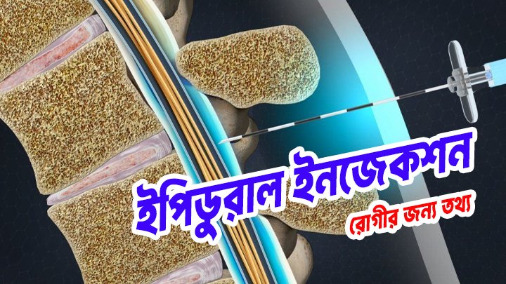 ইপিডুরাল ইনজেকশন: রোগীর জন্য তথ্য!