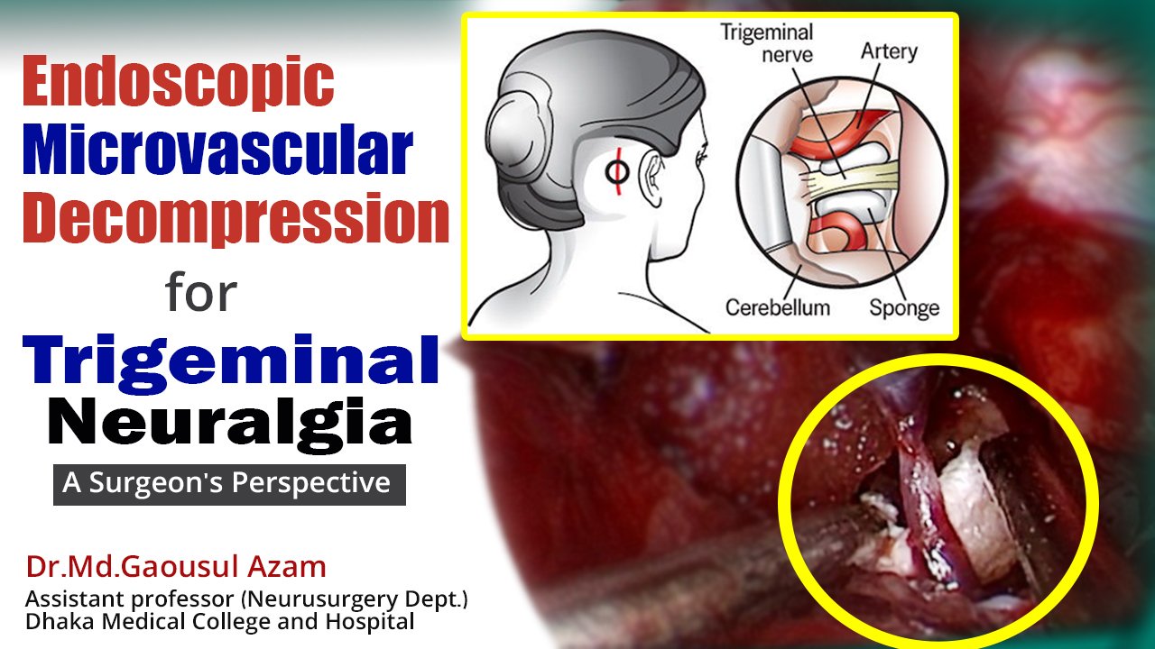 Endoscopic Microvascular Decompression for Trigeminal Neuralgia: A Surgeon's Perspective