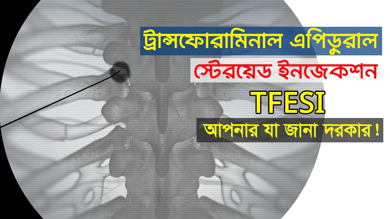 ট্রান্সফোরামিনাল এপিডুরাল স্টেরয়েড ইনজেকশন (TFESI) সম্পর্কে আপনার যা জানা দরকার!