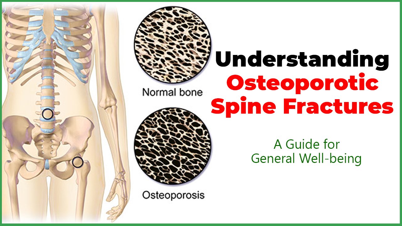 Understanding Osteoporotic Spine Fractures: A Guide for General Well-being.